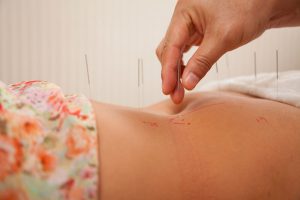 Woman getting acupuncture for infertility, Accurate Acupuncture, Phoenix, AZ
