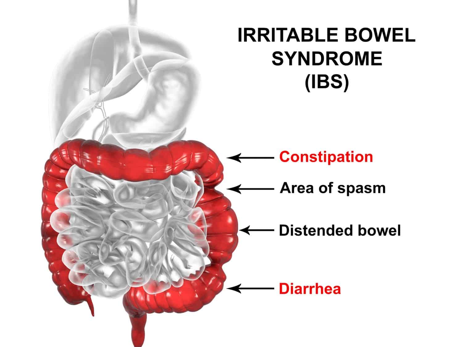 El tomate es malo para el colon irritable