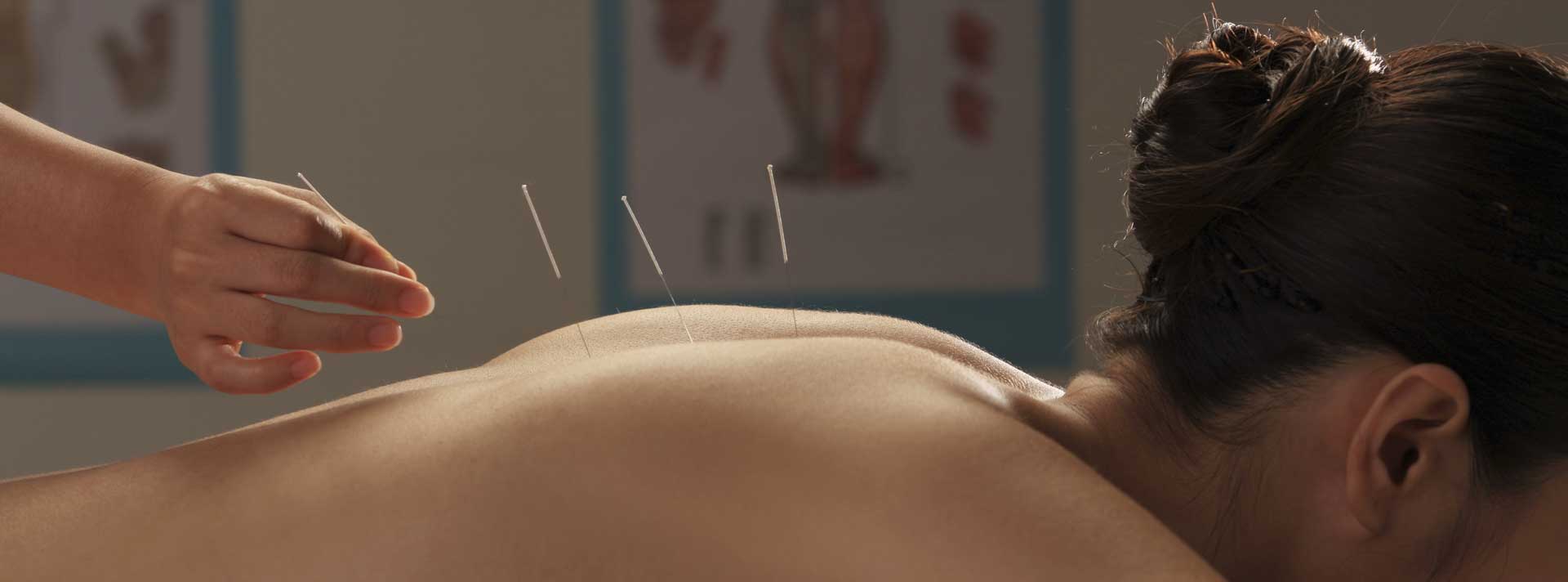 Accurate Acupuncture